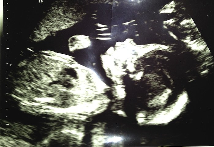 Zoey Ultrasound 2011